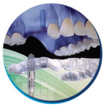 Implante Dentário Implante Dentário