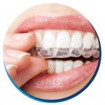 Aparelho Invisalign