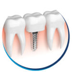 Prótese Dentária Prótese Dentária