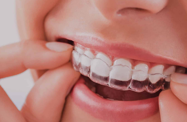 aparelho-invisalign